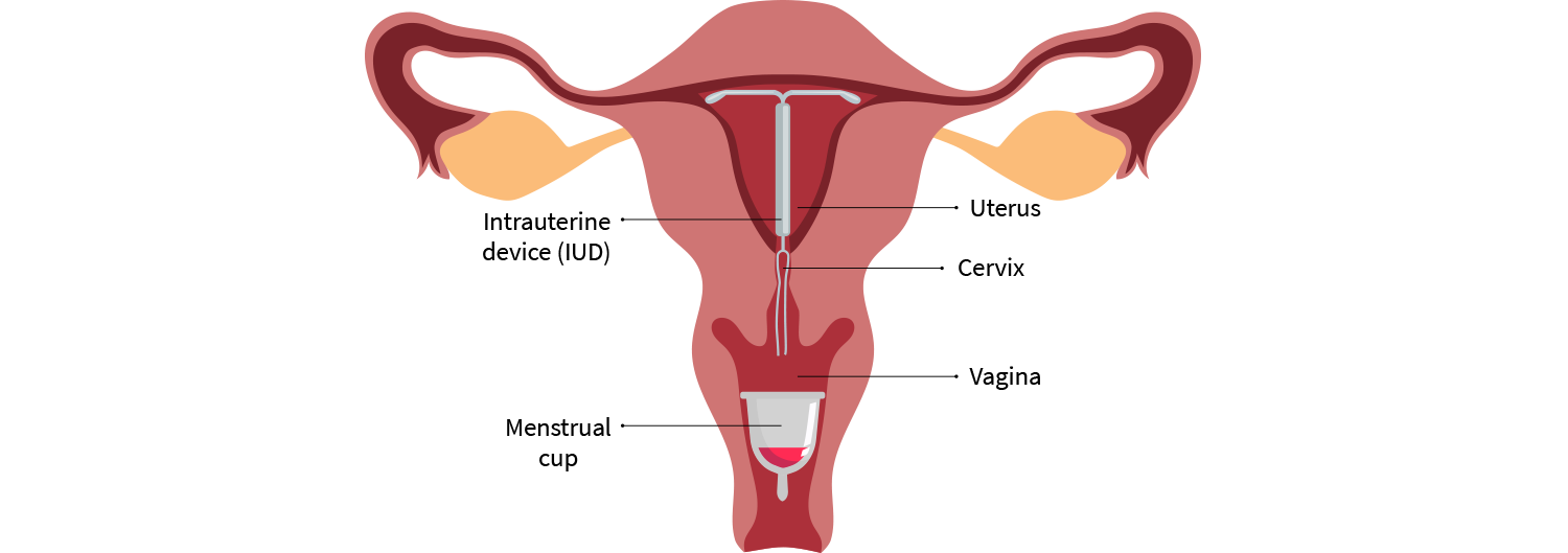 Menstrual cup and iud's